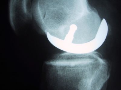 DePuy UKA (Implant 25)